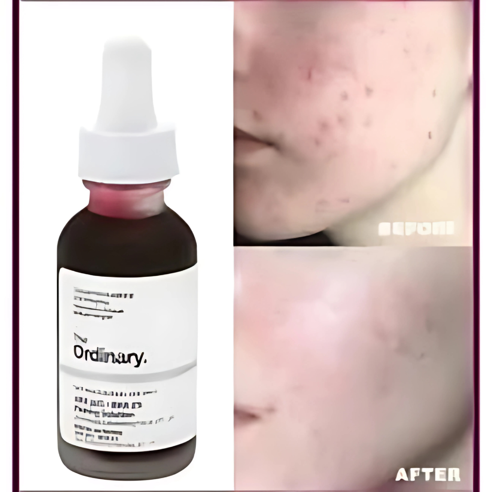 The Ordinary AHA 30% + BHA 2% Peeling Solution, Advanced Exfoliating Peel for Brighter Skin
